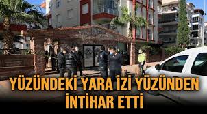 Check spelling or type a new query. Yuzundeki Yara Izi Yuzunden Intihar Etti Lider Gazete Antalya Haber Ve Antalya Spor Son Dakika Haberleri