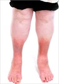 Image result for Lipodermatosclerosis