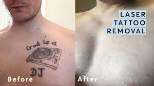 Surgical tattoo removal before after. Laser Tattoo Removal Before And After Through All The Stages Youtube