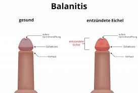 Balanitis Entzundung Der Eichel Ursachen Symptome Therapie