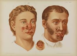 Image result for Tertiary Syphilis