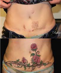 Ver más ideas sobre tatuaje en cicatriz, tatuaje para tapar estrias, tatuaje para cubrir cicatriz. El Antes Y Despues De Tatuajes Sobre Cicatrices Nos Muestran Una Manera Increible De Disimularlas