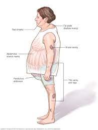 Cushing Syndrome Symptoms And Causes Mayo Clinic