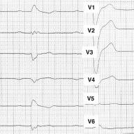 12 lead ecg & acs. Pdf Left Bundle Branch Block An Old New Entity