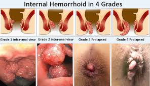 Image result for Hemorrhoid