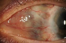 Image result for lesion sclera
