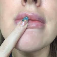 You don't have to press really hard. Faux Beauty Capillary Refill Haematoma Complication