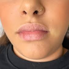 Hyaluron Pen Montpellier