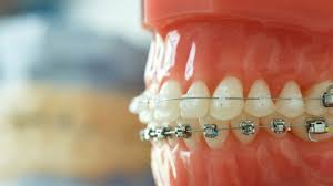 Don't try this at home. Faq Getting Braces Off Align Ortho