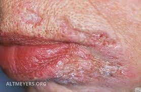Its name comes from a distinctive pattern seen on a chest radiograph of many tiny spots distributed throughout the lung fields with the. Tuberculosis Cutis Luposa Altmeyers Encyclopedia Department Dermatology
