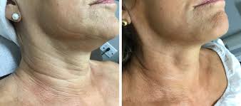 At brampton laser clinic you get a complete range of beauty treatments in a private and relaxing atmosphere. Laser Skin Treatments Brampton Mississauga Gta