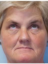 Brow Droop & Upper Eyelid Skin Excess* 1257