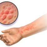 Allergie Au Chlore Symptomes Et Traitements