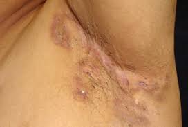 If your diet contains a lot of mucus producing food this can cause nodes to swell. Hidradenitis Suppurativa Picture Image On Medicinenet Com