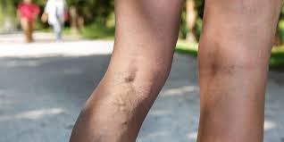 Penyakit ini tidak menular ataupun diturunkan. Dermatitis Stasis Kulit Meradang Akibat Sirkulasi Di Kaki Yang Tak Lancar