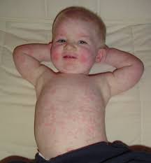 Image result for Generalized Rash