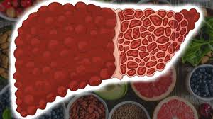 Potrivit globocan (global cancer observatory), în românia sunt diagnosticate anual peste 11.000 de cazuri noi de cancer pulmonar, dintre care peste 8.000 în rândul bărbaţilor. Sase Alimente Care Combat Cancerul Cancer La Ficat Regim Alimentar