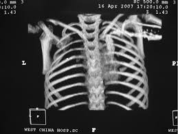 The carina is an important landmark when assessing chilaiditi syndrome involves the abnormal position of the colon between the liver and the diaphragm resulting in the. Autologous Rib Transplantation And Terylene Patch For Repair Of Chest Wall Defect In A Girl With Poland Syndrome A Case Report Journal Of Pediatric Surgery
