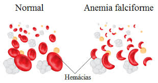 Resultado de imagem para hemacia hemoglobina a