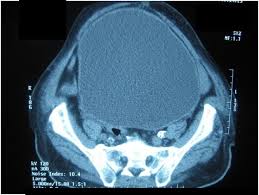 Distended Bladder Presenting With Constipation And Venous Obstruction A Case Report Journal Of Medical Case Reports Full Text
