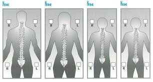 posture chart hudson valley scoliosis