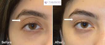 eyelid filler injection  dark circles