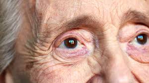 Symptoms of cataracts include cloudy or fuzzy vision and sensitivity to glare. Using Optical Sensing For Cataract Diagnoses Ocean Insight