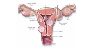 Read all information of uterine fibroids symptoms, treatments, causes, tests & preventions. Best Uterine Fibroids Treatment Hospitals Specialist In India Rg Hospital