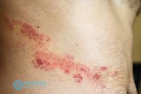 Image result for shingles
