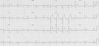 Sinus Arrhythmia Litfl Medical Blog Ecg Library Basics