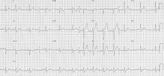 Sinus Arrhythmia Litfl Medical Blog Ecg Library Basics