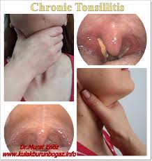 Image result for Tonsillitis