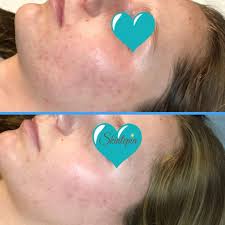 We use it for fine lines and wrinkles and we do it for acne scars. Microneedling Facial Skintopia Scottsdale