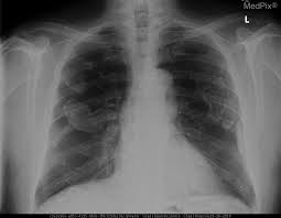 This page provides essential information . Medpix Case Asbestos Related Pleural Plaques
