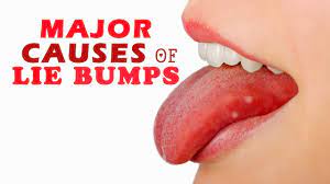 Once you start to use it, you do not have to wait too long to feel relief. Lie Bumps Causes Symptoms Treatment And Prevention