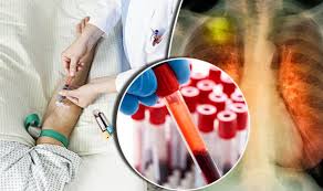 If the initial blood test for a woman picked up high levels of one of the genes or proteins indicative of cancer, they were invited back for a. Lung Cancer Treatment Blood Test Can Spot Signs Of Disease Five Years Before Scan Express Co Uk