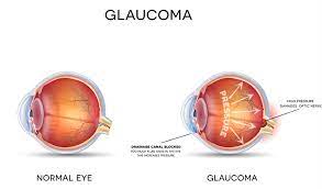 Glaucoma Optometrist In Duluth Mn Theobald Family Eye Care