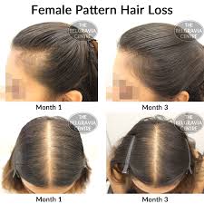 Age, sex, hormone and genetics play great roles in determining the quality as we … After Her First Belgravia The Belgravia Hair Loss Centre Facebook