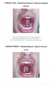 Drinking all of your liquids through a straw will help you exercise your tongue and get you used to the feeling of having your tongue retracted. Lisp Treatment Emeryville Ca Dentist