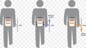 Peritoneal Dialysis Bathroom Public Toilet Male Clip Art Png 1069x591px Peritoneal Dialysis Bathroom Dialysis Female Hardware Pin the clipart you like. peritoneal dialysis bathroom public