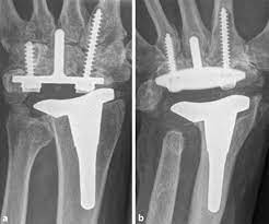 Sklep internetowy witaminyswanson.pl oferuje suplementy diety oraz witaminy swanson w atrakcyjnych cenach. Revisionen Nach Implantation Von Totalendoprothesen Am Handgelenk Springerlink