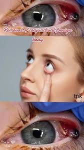 Image result for Conjunctival Foreign Body