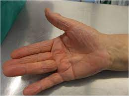 Cirugía reparadora del cartílago articular (autoinjertos, mosaicoplastias, perforaciones, aloinjertos, autotrasplante de condrocitos cultivados) lesiones de los ligamentos de la rodilla; Enfermedad De Dupuytren Y Sus Posibles Tratamientos