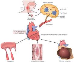 Rheumatic Fever And Rheumatic Heart Disease Rheumatic Fever Q Fever Nurse Practitioner School