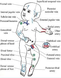 Image result for Difficult Intravenous Access in Children