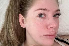 Image result for skin cancer on nose pimple