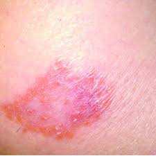 * forma luposa = granuloma es completo. Erythematous Plaque Like Form Of Lupus Vulgaris Under Pressure Through Download Scientific Diagram