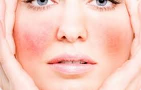 Lasers or ipl (intense pulsed light) are often used to treat spider veins of the face. 5 Ways To Treat Spider Veins Of The Face