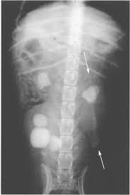 Image result for Perinephric Abscess