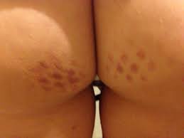 I like to have guys use a benzoyl peroxide wash or soap on the buttocks and back if they are experiencing breakouts, says dr. Bruised Buttocks From Sitting Warning Picture June 2016 Babies Forums What To Expect